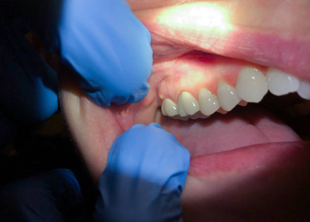 Best Knocked-Out Tooth (Avulsed Tooth) Treatment in Williamston, NC